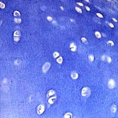 patologie della cartilagine articolare